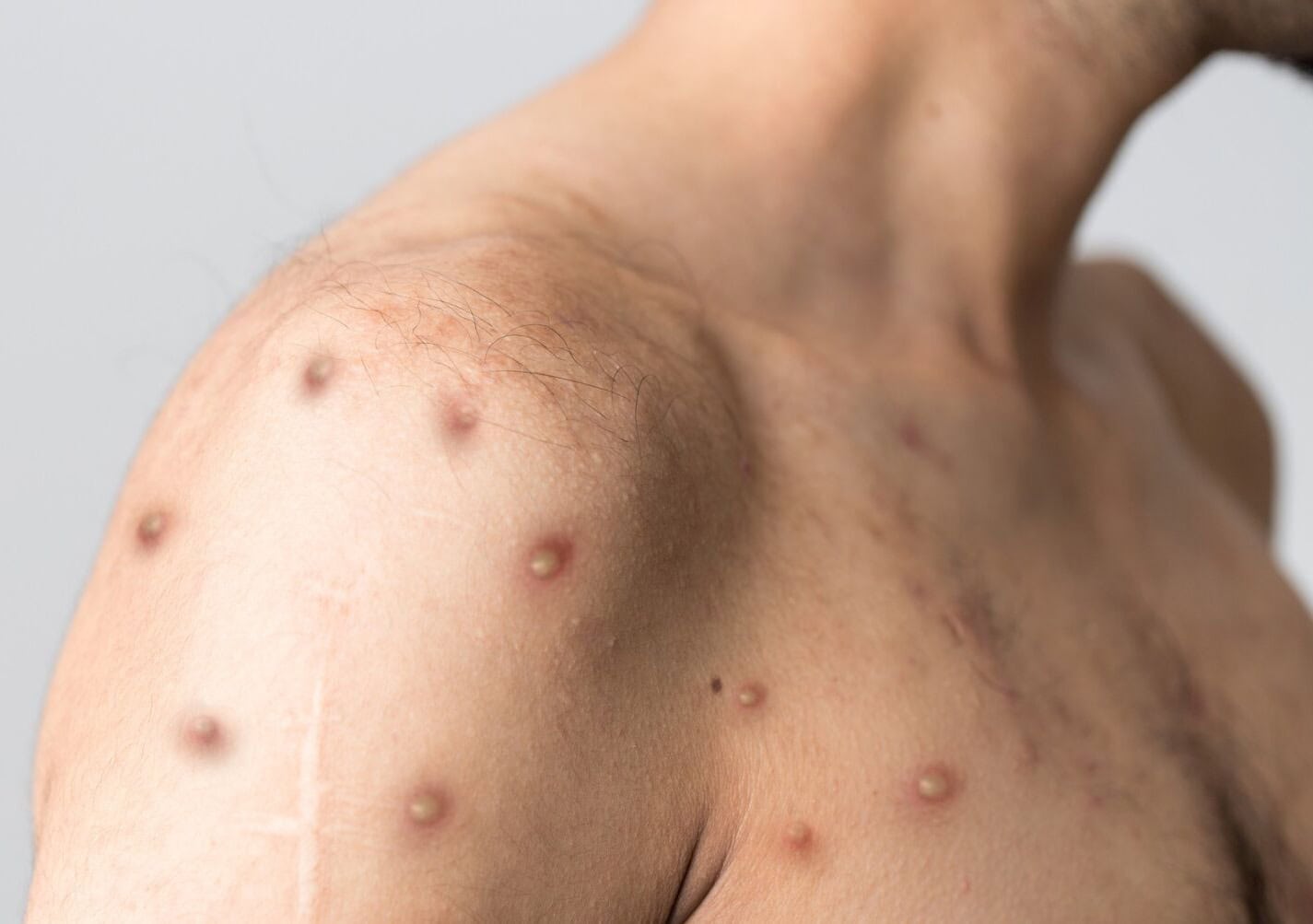 Brazilian Ports and Airports Must Display Informational Materials on Mpox